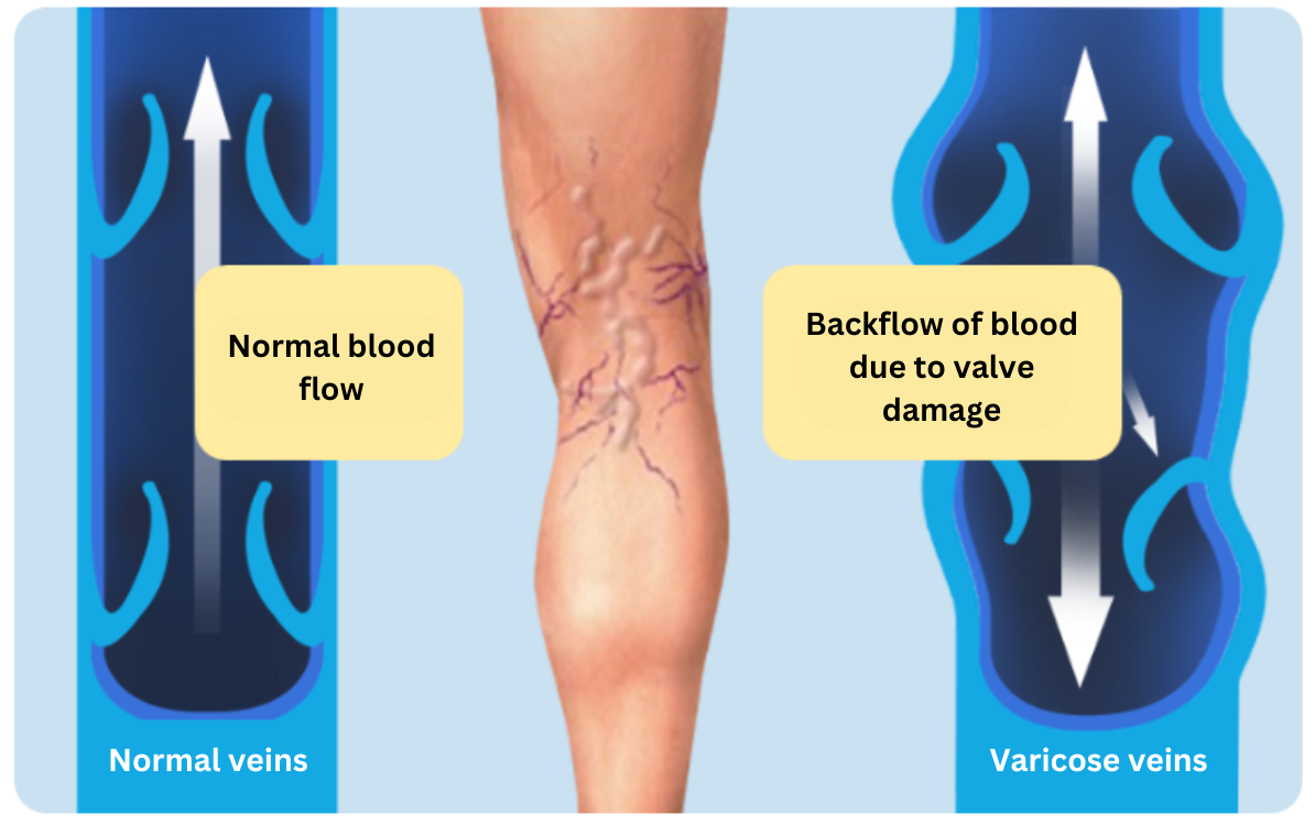 Varicose Vein treatment korea - Varicose Vein